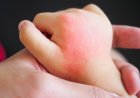 When to Worry About a Rash on Your Toddler - Eblogazine