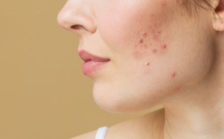 Natural Remedies for Fungal Acne: Home Remedies that Actually Work