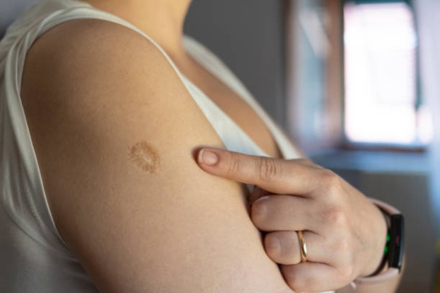 Smallpox Vaccine Scar: What Is It and Why Do We Have It?