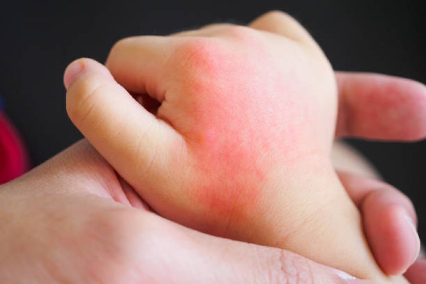 When to Worry About a Rash on Your Toddler - Eblogazine